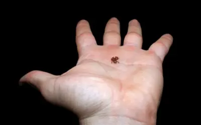 Sapinho da Mata Atlântica com menos de 7 milímetros é o segundo menor vertebrado já descrito no mundo
